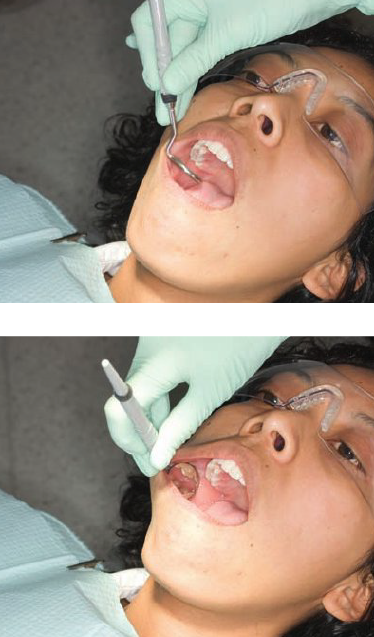 <p><strong>Step 1 </strong></p><ul><li><p>1 to 2 o’clock for facial aspect of mandibular right posteriors </p></li><li><p>Hold mirror in non dominant hand </p></li><li><p>Put mirror head between dental arches w/ reflecting surface parallel to maxillary occlusal surfaces (Frisbee—style) </p></li><li><p>Slide mirror back until its in line w/ second molar </p></li></ul><p></p><p><strong>Step 2</strong></p><ul><li><p>Turn mirror handle until head is parallel to buccal mucosa </p><ul><li><p>Back of the head is against inside of cheeks</p></li></ul></li><li><p>Establish extraoral finger rest on side of patient’s cheeks</p></li><li><p>Use arm muscles for retraction</p><ul><li><p>Don’t use finger muscles — difficult and tiring way to retract cheeks</p></li></ul></li></ul><p></p><p><strong>Avoid hitting mirror against patient’s teeth or resting outer rim of mirror head against patient’s gingival tissues </strong></p><ul><li><p>Use mirror head, not shank for retraction (don’t retract at corner of mouth) </p></li></ul><p></p>