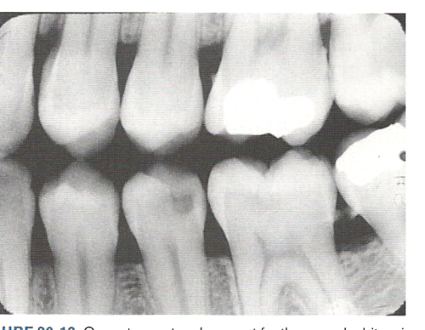 <p>a cavity detecting film showing the crown and interproximal areas of teeth</p>