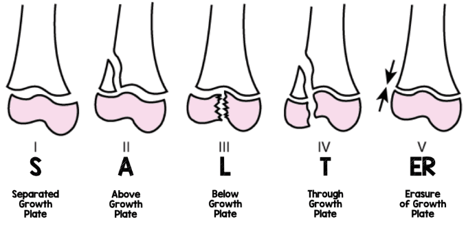 <p>Fracture through the growth plate of a child’s bone</p>