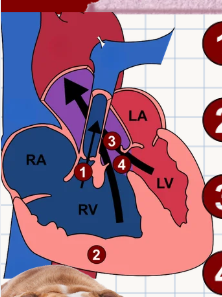 <p>List the <strong>4 distinct anatomical anomalies</strong> that define the complex congenital defect <strong>Tetralogy of Fallot (ToF)</strong>:</p>