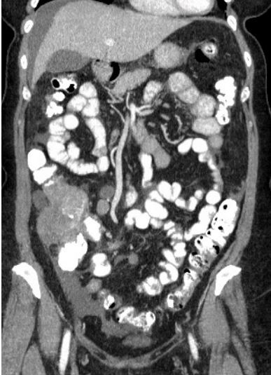 <ol><li><p>Imenuj tehniko slikanja </p></li><li><p>Naštej anatomske strukture, prikazane na sliki </p></li><li><p>Kateri je položaj slikanja? </p></li><li><p>Opiši patološke spremembe na sliki </p></li><li><p>Diagnoza?</p></li></ol><p></p>