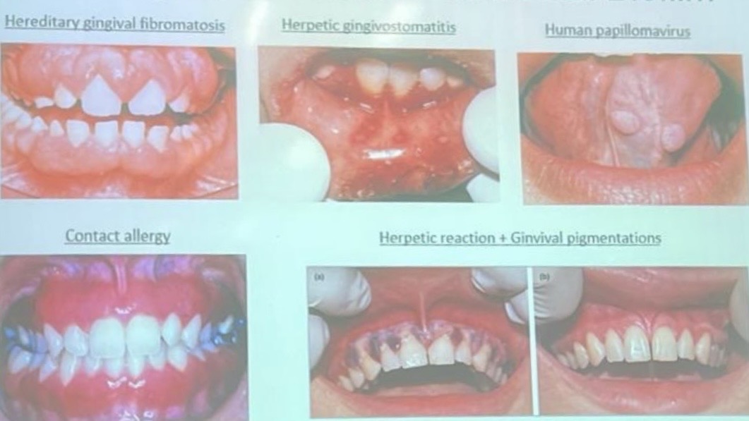 <p>Hereditary gingival fibrostomatitis</p><p>Contact allergy</p><p>Herpetic gingivostomatitis</p><p>HPV</p><p>Herpetic reaction and pigmentation</p>