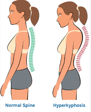 <p>hunchback, exagerated rounding of upper back</p>