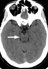 <p>A small part of the brain above the pons that integrates sensory information and relays it upward.</p>