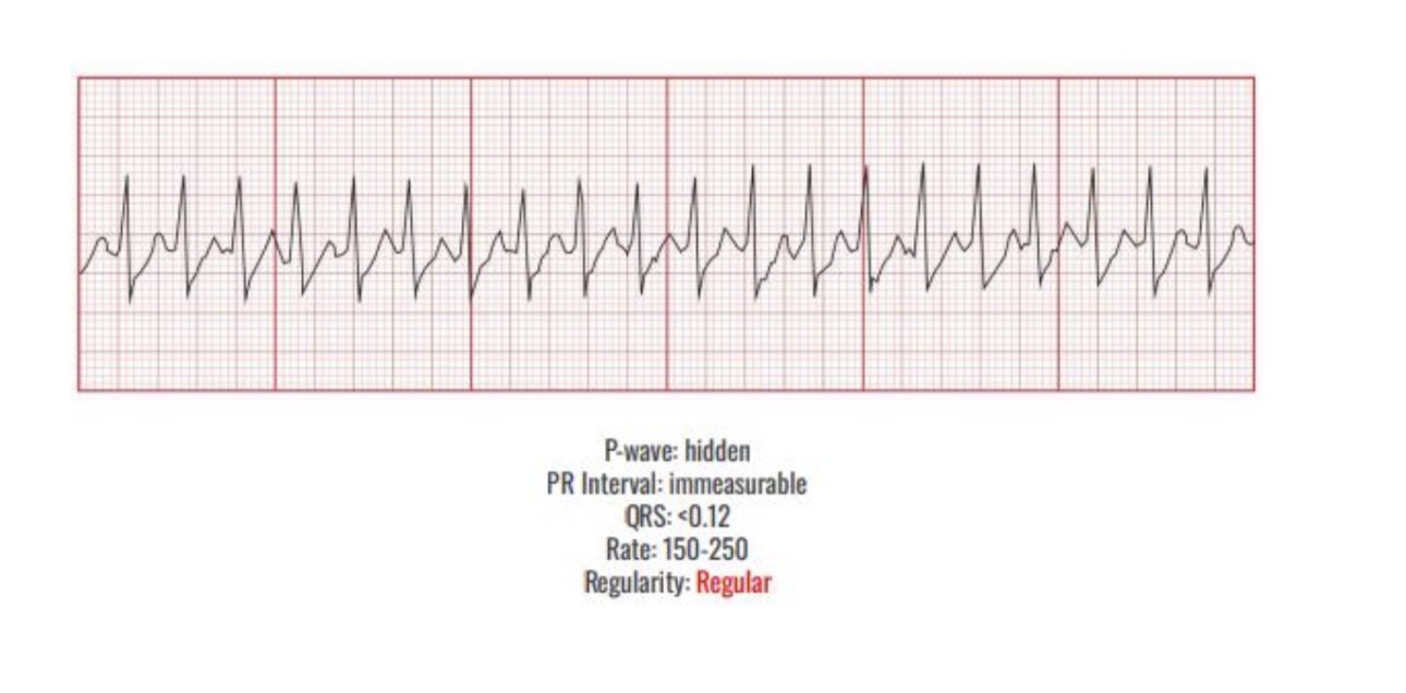 <p>Causes</p><p>Caffeine</p><p>CHF</p><p>Fatigue</p><p>Hypoxia</p><p>Pacemaker</p><p></p><p>Interventions </p><p>Cardioversion</p><p>Adenosine</p>