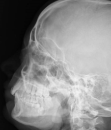 <p><span style="background-color: transparent;">Facial - LATERAL</span></p>