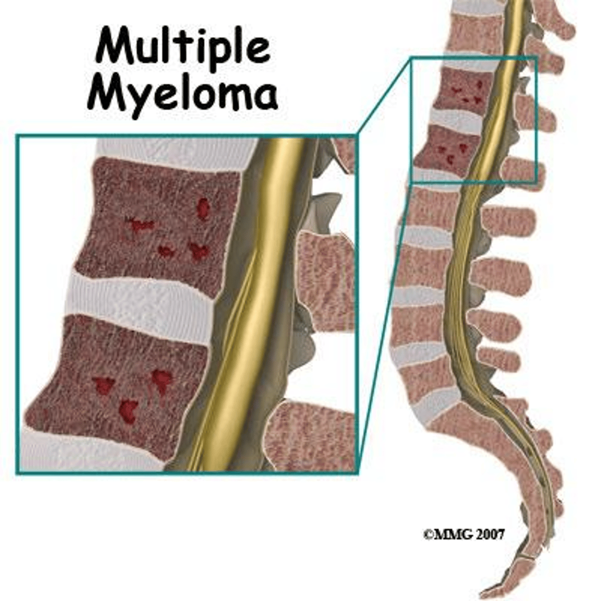 <p>Osteolytic bone lesions, elevated calcium, and Bence Jones proteins.</p>