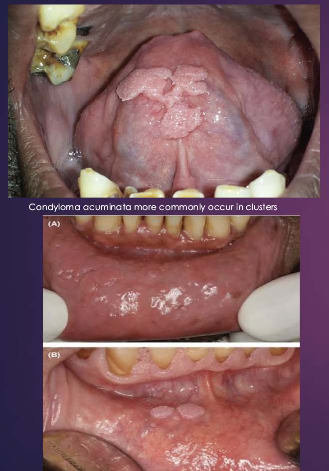 <p>Clinical Info: <strong>Condyloma Accuminatum</strong></p>