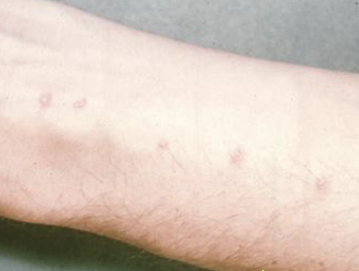 <p>What disease is this? What parasite causes it?</p>