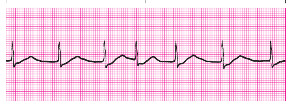 <ol><li><p>Regularity?</p></li><li><p>Rate</p></li><li><p>P Waves</p></li><li><p>PRI</p></li><li><p>QRS</p></li><li><p>Interpretation</p></li></ol><p></p>