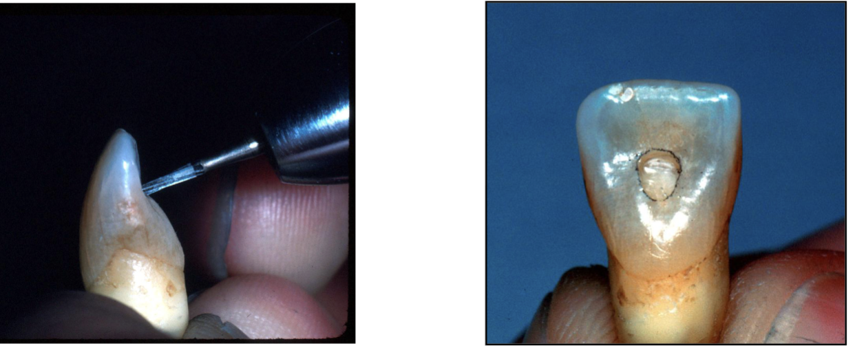<p>#701: about ~1.5 mm depth, hold perpendicular to tooth to get under incisal edge </p>