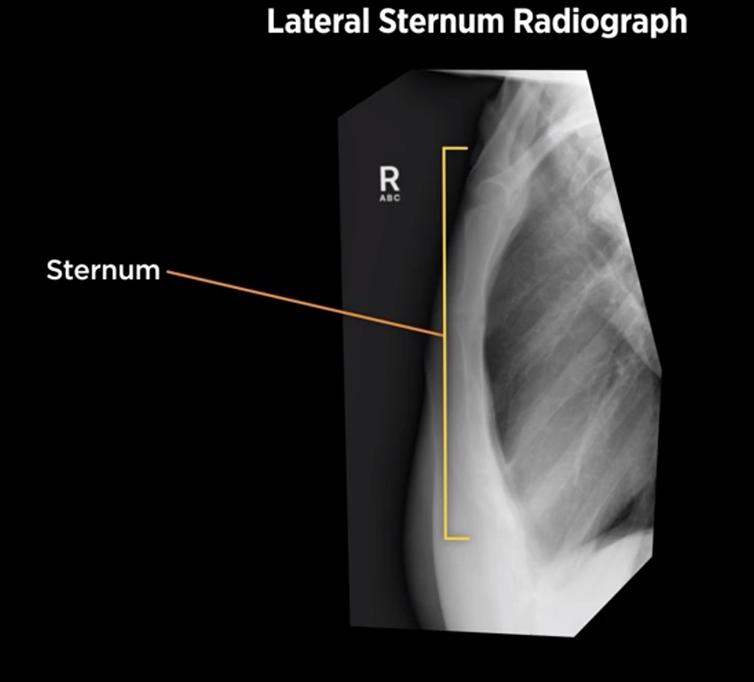 <p>CR at lateral border of the sternum</p>