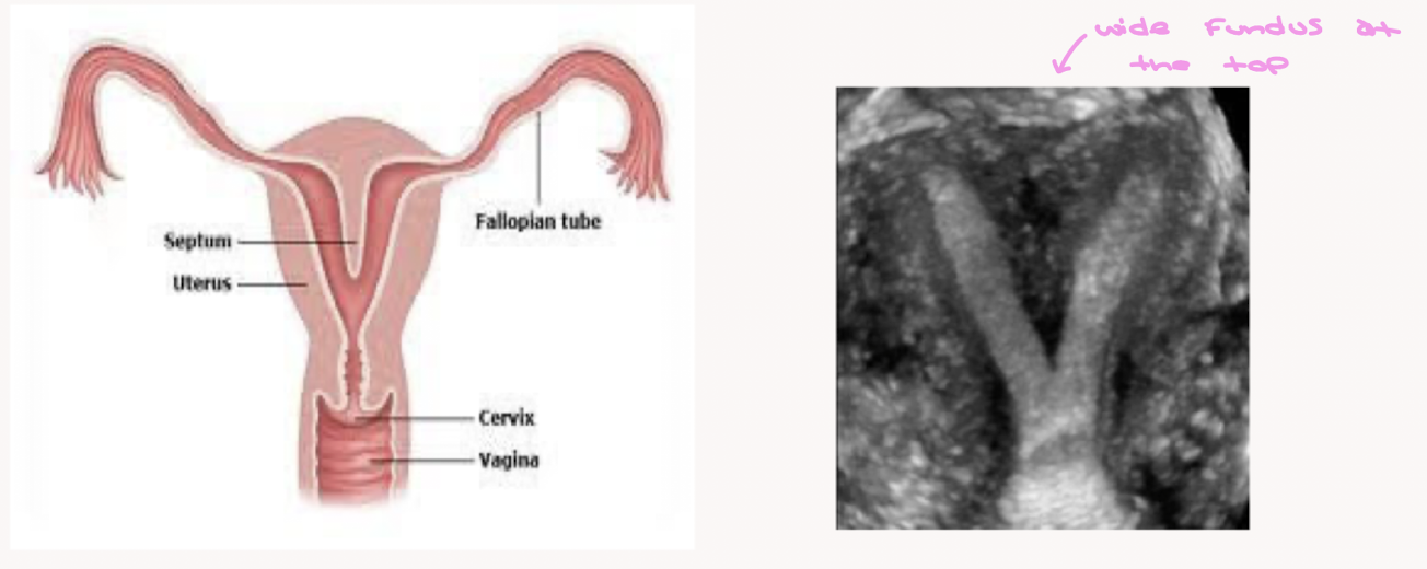<p>Name the uterine anomaly </p>