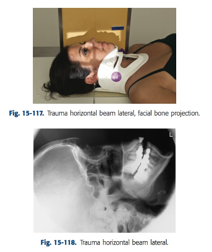 <ul><li><p>Horizontal beam is essential for visualization of intracranial air fluid levels</p></li><li><p>Center CR to the zygoma, midway between the outer canthus and EAM</p></li><li><p>Place lengthwise IR closest to the side of interest and center to the CR</p></li><li><p>Head placement on table because don’t need back of skull</p></li></ul><p></p>
