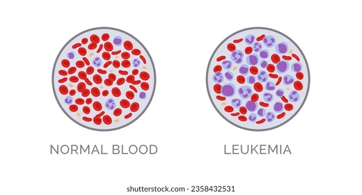 <p>Blood cancer is when bad cells affect the blood and stop it from working properly.</p><p>Example: The body cannot fight infections well.</p>