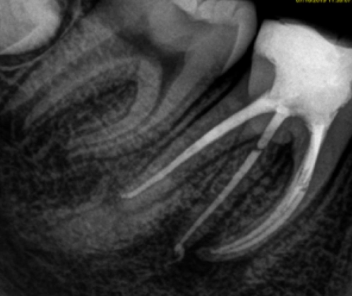 <p>What is an anatomical variation where an extra, third root is present on a mandibular molar, typically the first molar?</p>