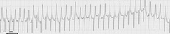 <p>Describe this ECG during exercise</p>