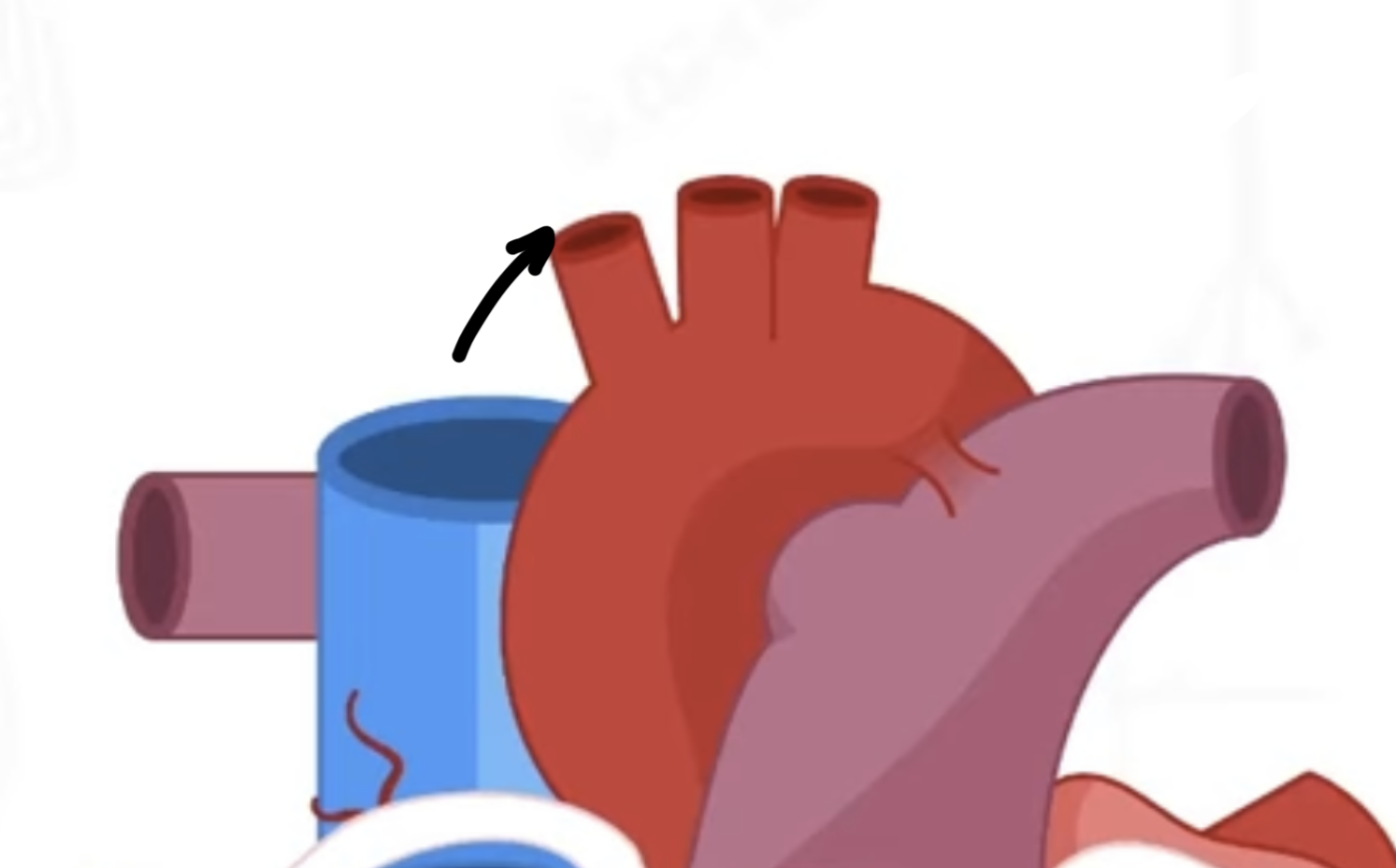 <p>right-most vessel on the aortic arch</p>