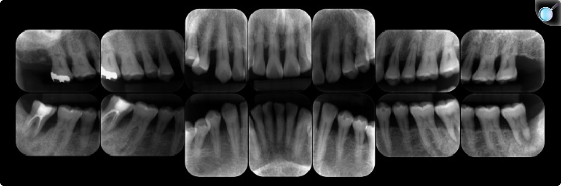 <p>Idade: 41 anos</p><p class="has-focus">queixando-se principalmente de inchaço e dor na gengiva ao redor do dente 47. O paciente apresentava boa saúde geral</p><p class="has-focus is-empty is-editor-empty">Tabagismo: fumante há 31 (começou com 10y)</p><p class="has-focus is-empty is-editor-empty">(<span>aproximadamente 20 cigarros por dia)</span></p><p class="has-focus is-empty is-editor-empty">PS ≥ 4 mm em 72,6% dos sítios</p><p class="has-focus is-empty is-editor-empty">Sangramento à sondagem (SS): 45,2% dos sítios</p><p class="has-focus is-empty is-editor-empty">Perda óssea/ Reabsorção óssea:</p><p class="has-focus is-empty is-editor-empty">Até o ápice radicular nos dentes 37 e 47</p><p class="has-focus is-empty is-editor-empty">Perda óssea angular nos dentes 17 e 24</p><p class="has-focus is-empty is-editor-empty">Reabsorção horizontal nas demais áreas</p><p class="has-focus is-empty is-editor-empty">Envolvimento de furca: dentes 17, 27, 37 e 47</p><p class="has-focus is-empty is-editor-empty">Dentes 37 e 47: extraídos devido à perda óssea até o ápice</p><p class="has-focus is-empty is-editor-empty">Diagnóstico: Periodontite estágio III, grau C</p><p class="has-focus is-empty is-editor-empty">Extensão: generalizada</p>