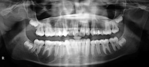 <p>Accidental finding, no expansion of bone</p>