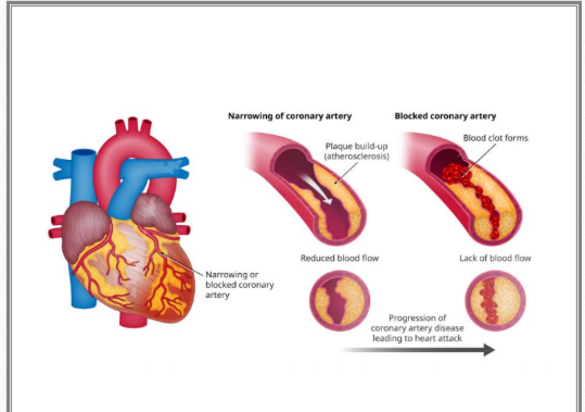 <p>A blockage prevents (O2) <strong>oxygen-rich blood from reaching the heart muscle</strong>, causing <strong>tissue death</strong>.</p>