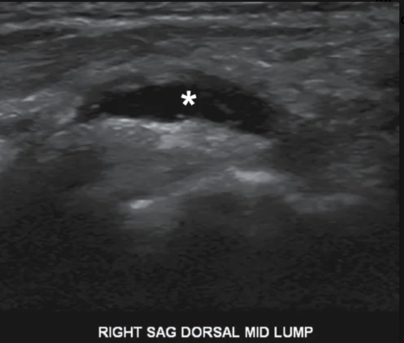 <p>If the abnormality in the image was noted in the region of the radial artery, it would so referred to as</p>
