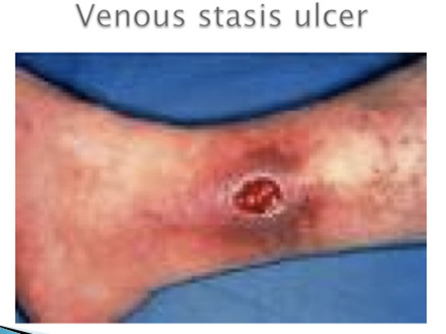 <p>bleed, medial malleolus</p>