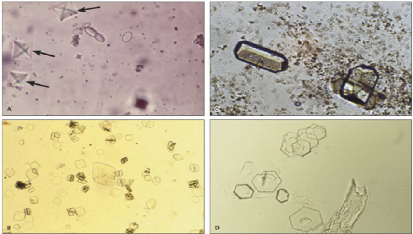 <ul><li><p>Typically seen in acidic urine.</p></li><li><p>Diamond or rhomboid in shape.</p></li><li><p>Yellow or yellow-brown.</p></li><li><p><strong>Commonly found in dalmations.</strong></p></li></ul><p></p>