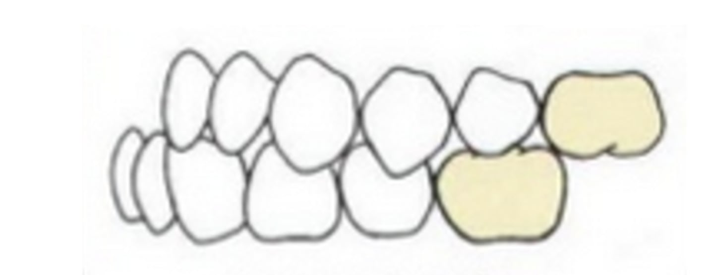 <p>When the mandibular 1st molar is positioned further <strong>mesial</strong> to the maxillary 1st molar</p>