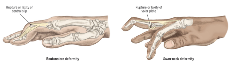 <p>pip flexion, Dip hyperextension </p><p></p><p>an injury to the <strong>central slip</strong>—the extensor tendon</p>