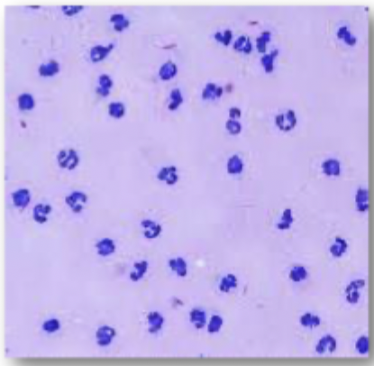 <p>This is synovial fluid was taken from the carpus of a dog with a fever.</p><ul><li><p>What are these cells?</p></li><li><p>Is this cytology consistent with normal, inflammatory or noninflammatory joint disease?</p></li><li><p>What are two differential diagnoses for this patient based on this cytology?</p></li></ul><p></p>