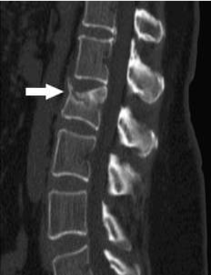<p>A collapse of a vertebra</p>