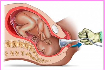 <p><strong>suction applied to baby’s head to assist expulsion</strong></p><p><strong>baby needs to be far enough along birth canal</strong></p><ul><li><p>only if <strong>occiput</strong> presentation (back of head facing vagina)</p></li><li><p>baby may render cephalic hematoma / bruising (chignon) </p></li></ul><p></p>