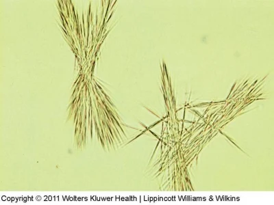 <p>Abnormal (acidic urine). Thin dark needles, colorless or pale yellow-brown </p><p>When found alone, suggests rare inherited metabolic disorder</p>