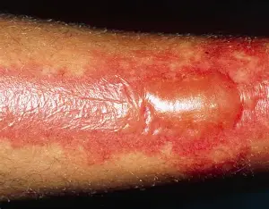 <p>Classification this burn is a</p>
