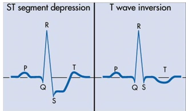 <ul><li><p>ST segment depression</p></li><li><p>T wave inversion</p></li></ul><p></p>