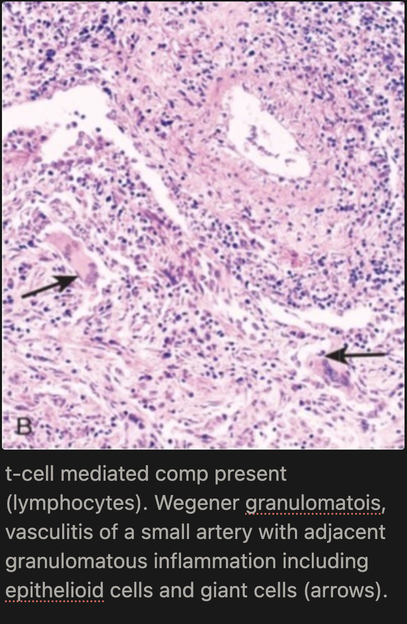 <p>Inflammatory sinusitis with mucosal granulomas → ulcerative lesions of nose, palate, pharynx rimmed by granulomas with geographic patterns of central necrosis + vasculitis (must distinguish from mycobacterial/fungal infections) [Necrotizing vasculitis + granulomatous inflammation + giant cells]</p>