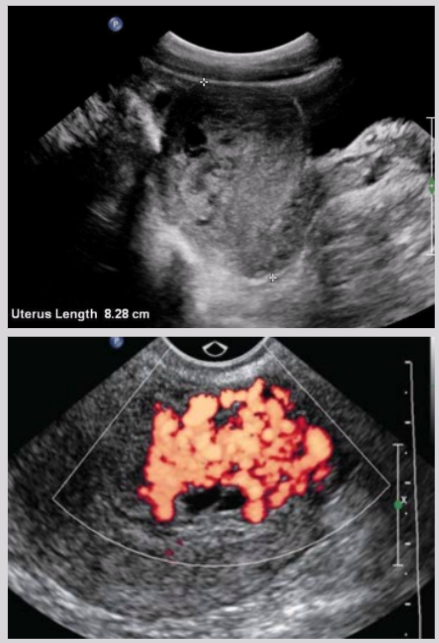 <ul><li><p><span style="background-color: transparent;">Heterogeneous uterine mass&nbsp;</span></p></li><li><p><span style="background-color: transparent;">Multiple lacunae surrounding mass w/ high-amp low-resistance blood flow</span></p></li></ul><p></p>