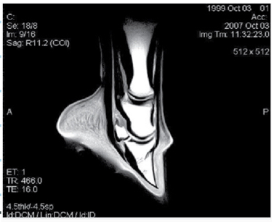 <p>Navicular Disease/ Palmer Digital Pain:C.S</p>