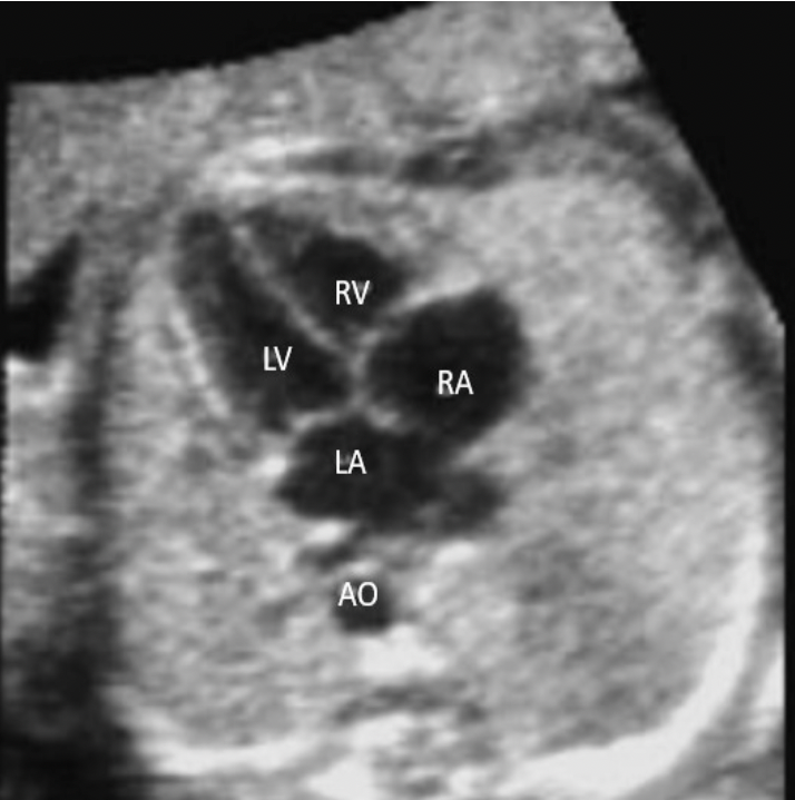 <p>C. right ventricle</p><p>The right ventricle is the most anterior chamber of the heart. The left atrium is the most posterior chamber of the heart.</p>