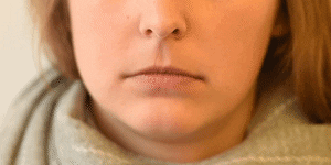 <p>Lip Corner Depressor</p>