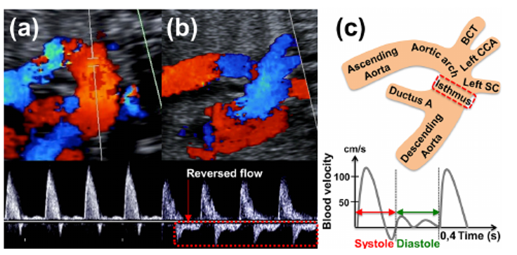 <p>slight constricion of the aorta immediately distal to the left subclavian artery at the point of attachment of the ductus arteriosus </p>