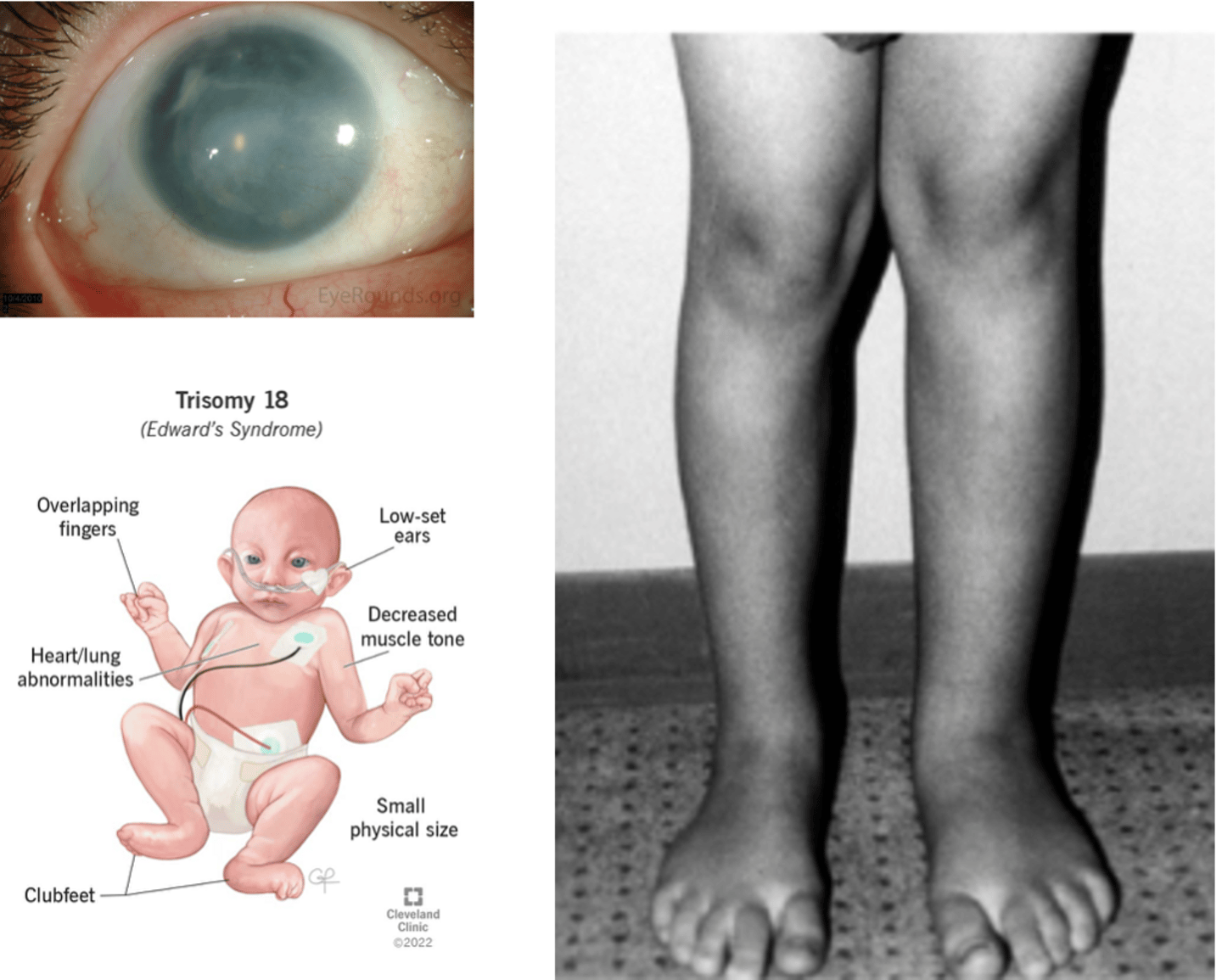 <p>Aniridia (absence of iris), hypospadias, cryptorchidism, hemihypertrophy, trisomy 18</p>