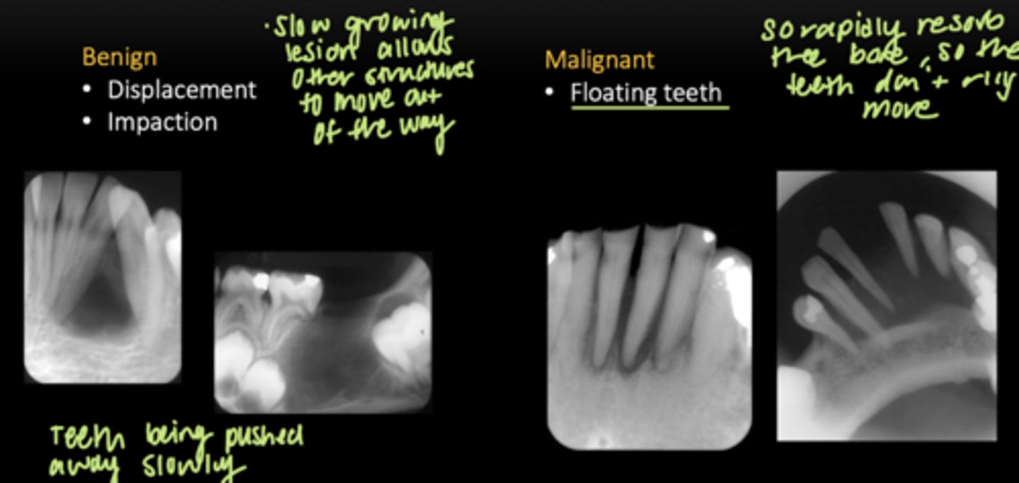 <p>Benign: </p><p>- Displacement </p><p>- Impaction </p><p>Malignant: </p><p>- FLoating teeth </p>
