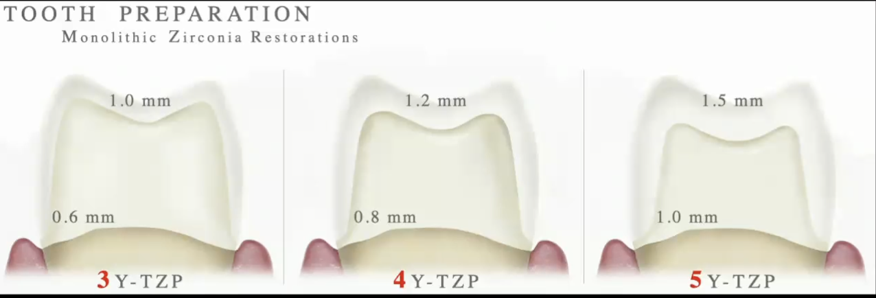 <p>minimum: </p><ul><li><p>3Y: 1mm reduction, .6 mm margin </p></li><li><p>4Y: 1.2 mm reduction, .8 mm margin </p></li><li><p>5Y: 1.5 mm reduction, 1 mm margin</p></li></ul><p></p>