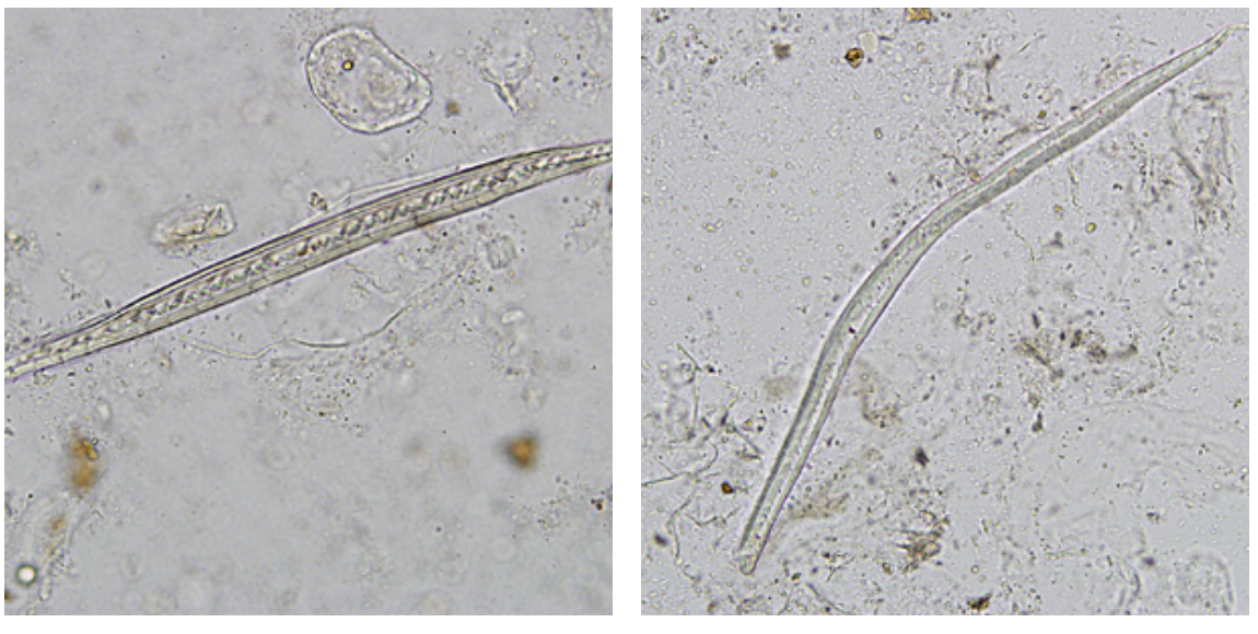 <p>plant fibers in stool that may resemble</p>