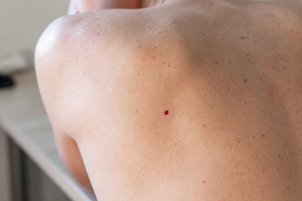 <p>A common benign growth made up of small blood vessels.</p>