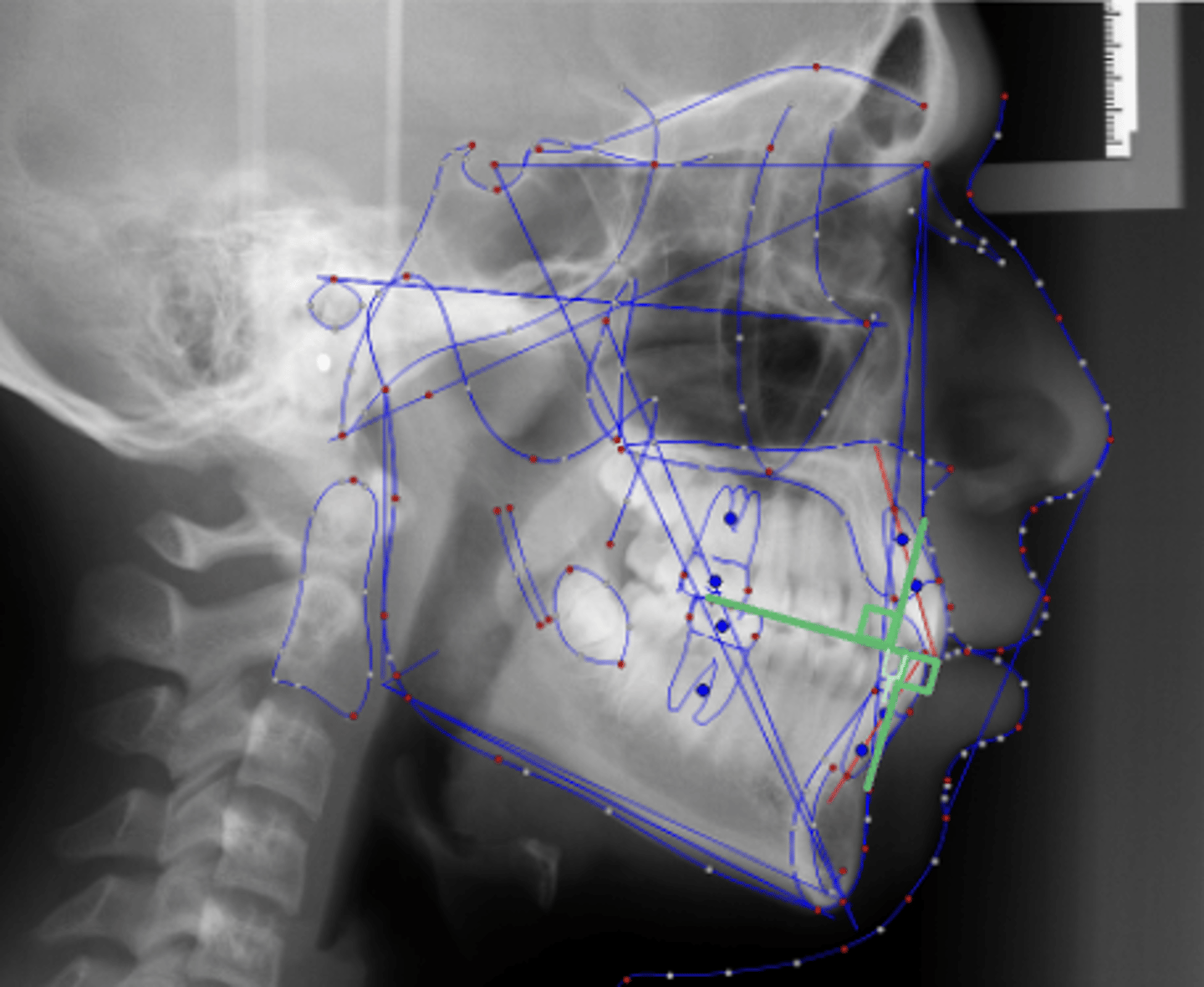 <p>What skeletal measurement:</p><p>- Distance between A point and B point measured along the occlusal plane</p><p>- AP relationship between the maxilla and the mandible</p><p>- Tells you about the AP skeletal classification</p>
