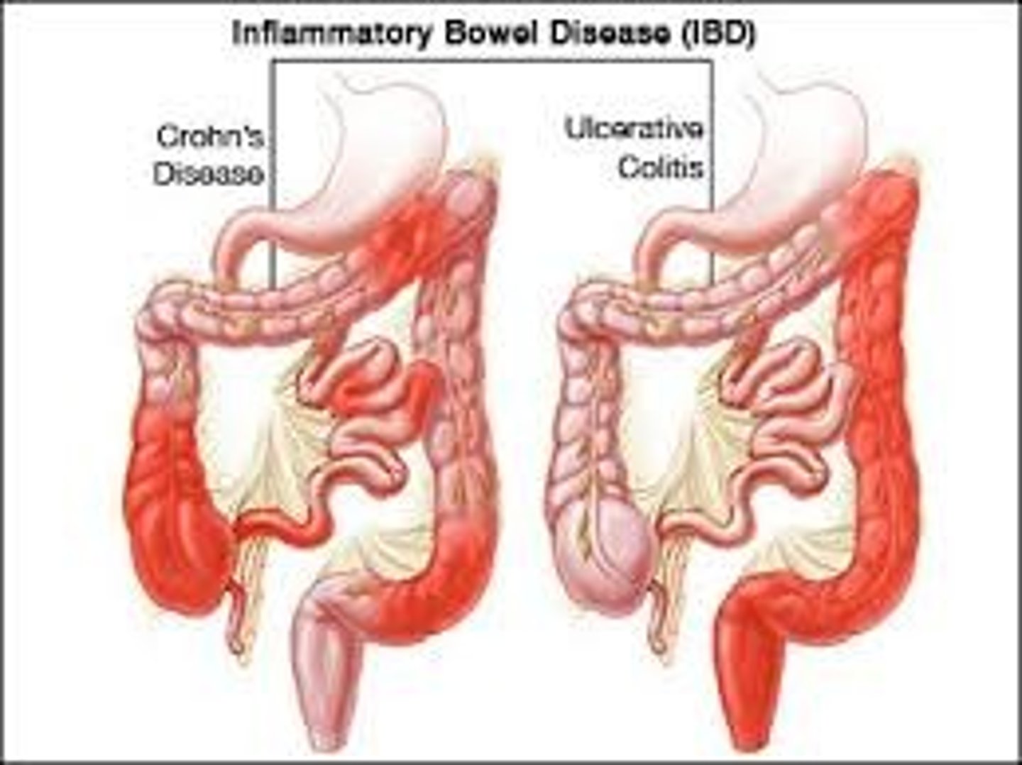 <p>inflammatory bowel disease (IBD)</p>