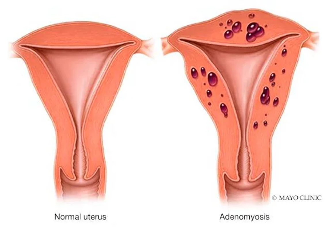 <ul><li><p>Endometrial cells from the lining of the uterus grow into the muscle wall </p></li><li><p>Causes</p><ul><li><p>Painful cramps </p></li><li><p>Heavy, prolonged menses</p></li><li><p>Dyspareunia </p></li><li><p><strong>Boggy</strong> appearance/texture </p></li></ul></li><li><p>Treatment</p><ul><li><p>Depends on severity </p></li><li><p>Conservative </p></li><li><p>Hormonal methods </p></li><li><p>Hysterectomy </p></li></ul></li></ul><p></p>
